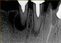 x-ray before implant
